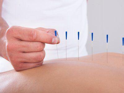 Иглотерапия: целая наука