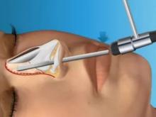 Искривление носовой перегородки