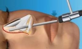 Искривление носовой перегородки