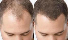 Когда волосы нужно спасти: лечение миноксидилом