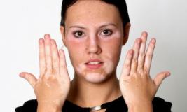 Существуют ли способы лечения витилиго?